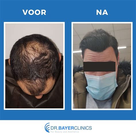 Haartransplantatie Voor En Na Foto's Van Succesvolle Patiënten