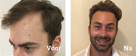 Het Effect Van Leefstijl Op Haartransplantatie Resultaten