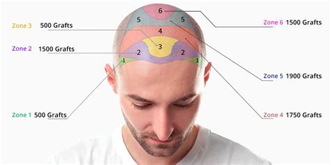 Haartransplantatie Kosten Factoren: Wat Beïnvloedt De Prijs?