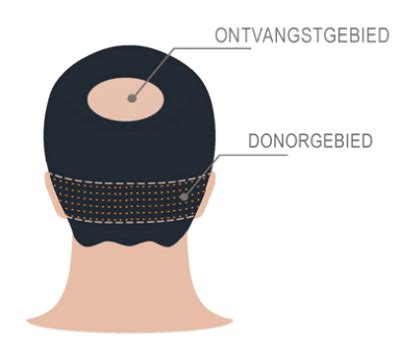 Haartransplantatie: Wat U Moet Weten