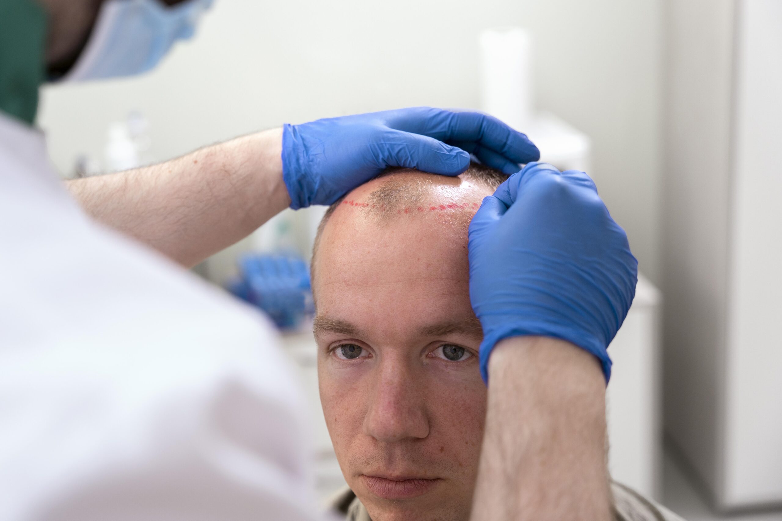 beste kliniek in nederland haartransplantatie