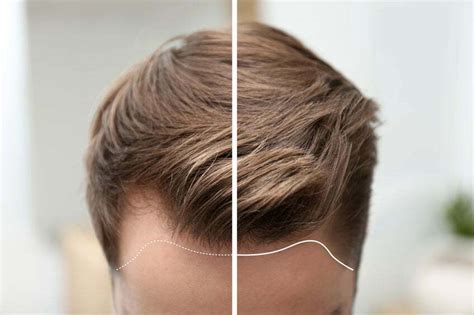 Haartransplantatie Trends: Wat Zijn De Laatste Ontwikkelingen?