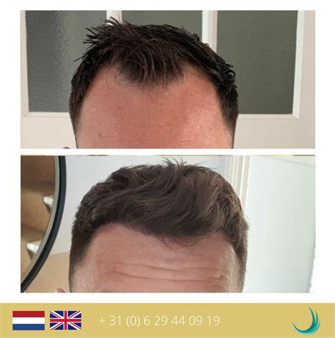 DHI: De Nieuwe Trend In Haartransplantatie