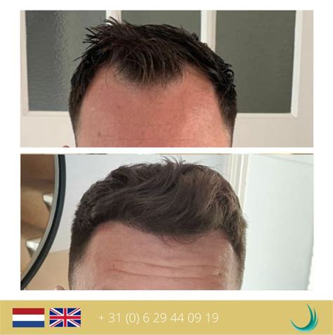 Haartransplantatie DHI: Hoe Het Verschilt Van Andere Methoden