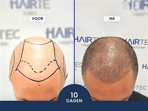 Haartransplantatie In Nederland: Wat Te Verwachten