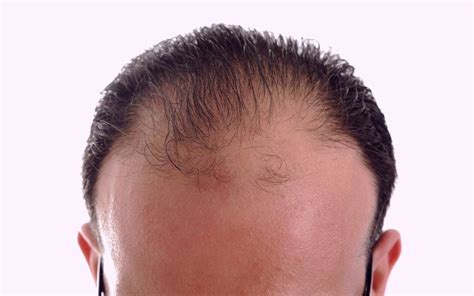 Haartransplantatie: Mythen En Feiten