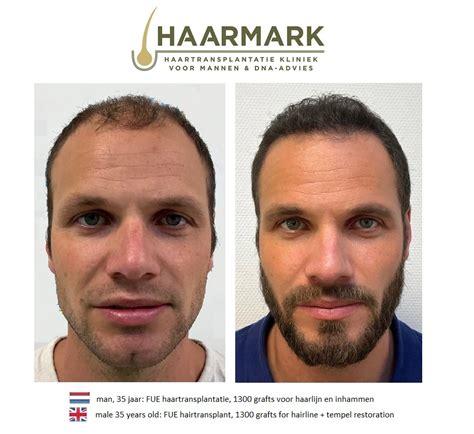 Haartransplantatie Voor En Na Foto’s: Echte Resultaten
