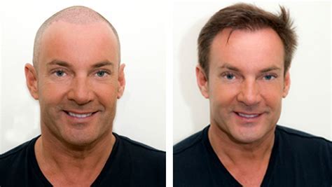 Haartransplantatie Voor En Na: Realistische Resultaten