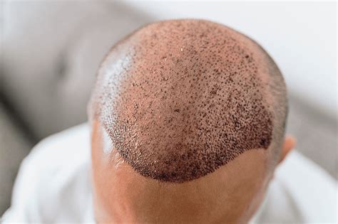 Haartransplantatie: Wat Je Moet Weten